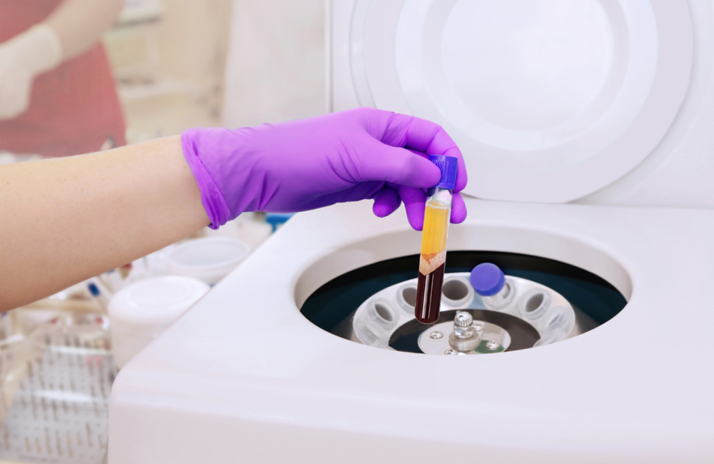 Eigenblutverfahren wie IRAP und ACP/PRP